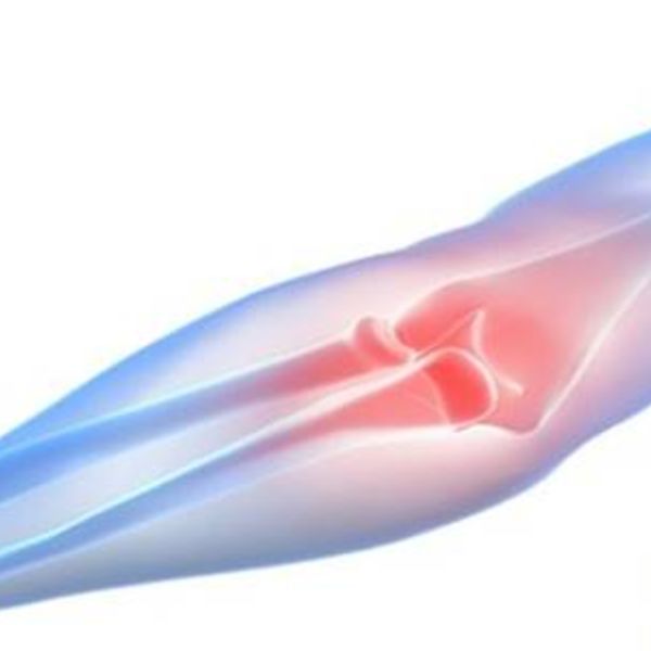 宇都宮で肘の骨挫傷治療はみやざき整骨院